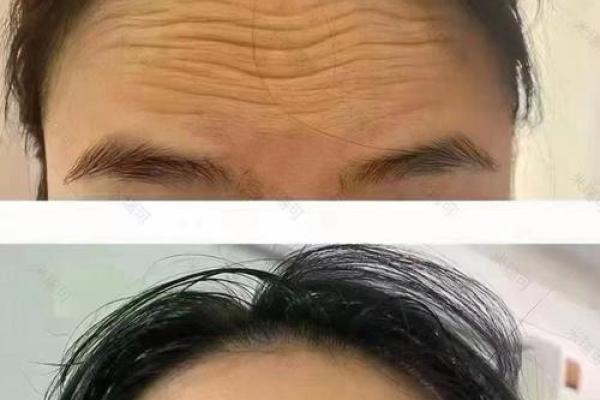 男性额头皱纹透露的年龄秘密