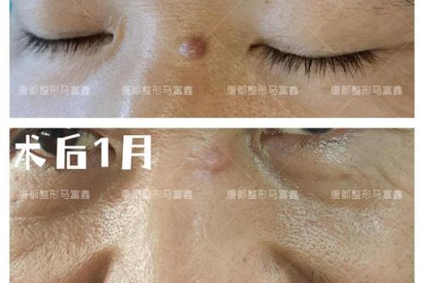 鼻痣之谜，揭秘富贵命！
