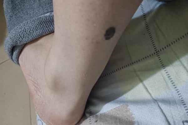 红痣点缀，小腿内侧的神秘魅力！